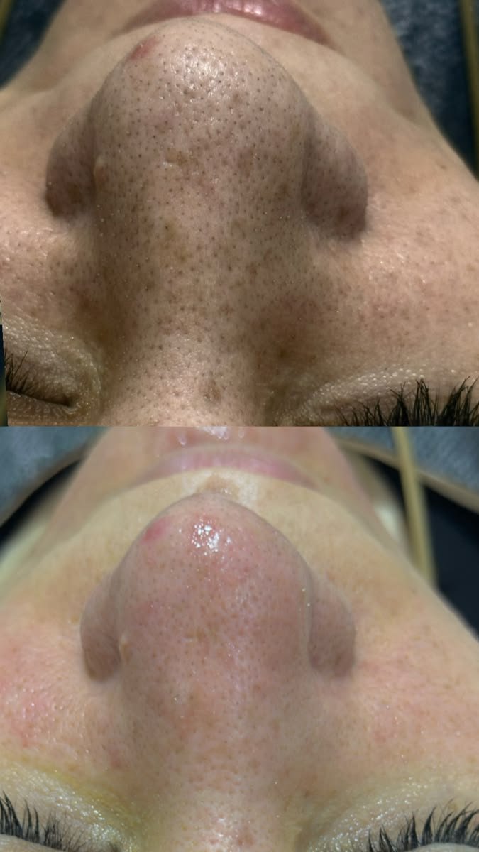 Clinical HydraFacial MD Instant Dewy Glow