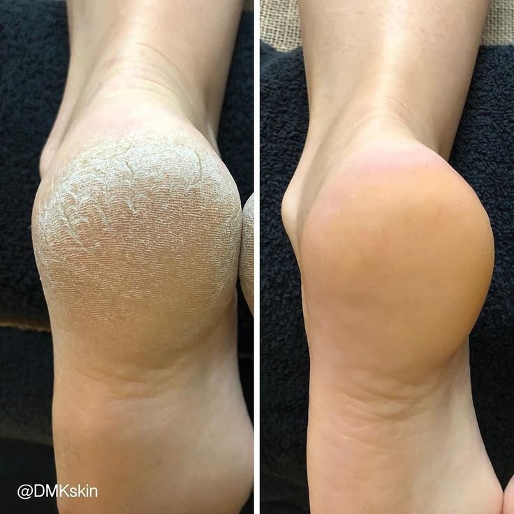 Heel Peel Callus & Cracked Heel Rejuvenation